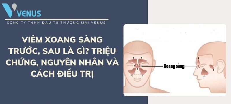 Viêm xoang sàng và những triệu chứng thường gặp