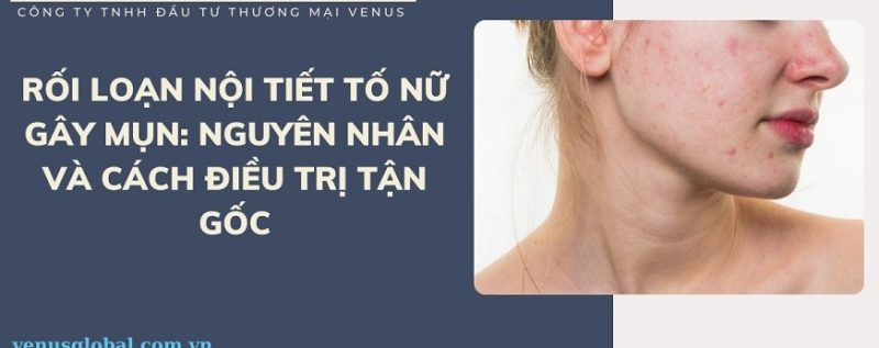 Rối loạn nội tiết tố nữ gây mụn và cách điều trị