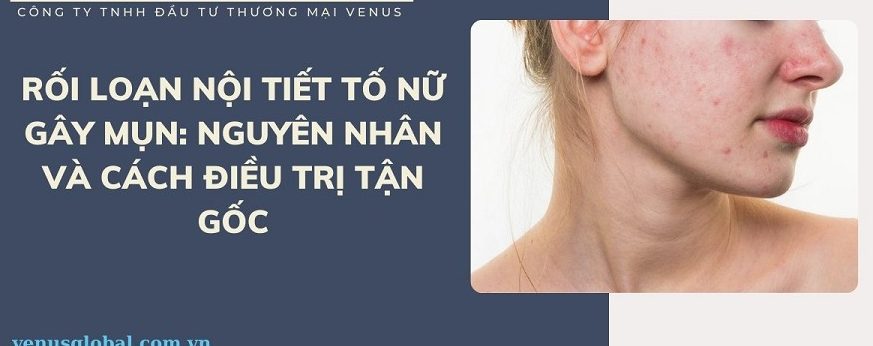 Rối loạn nội tiết tố nữ gây mụn: Nguyên nhân và cách điều trị tận gốc