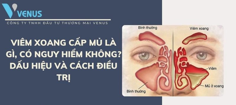 Tìm hiểu cách điều trị bệnh viêm xoang cấp mủ